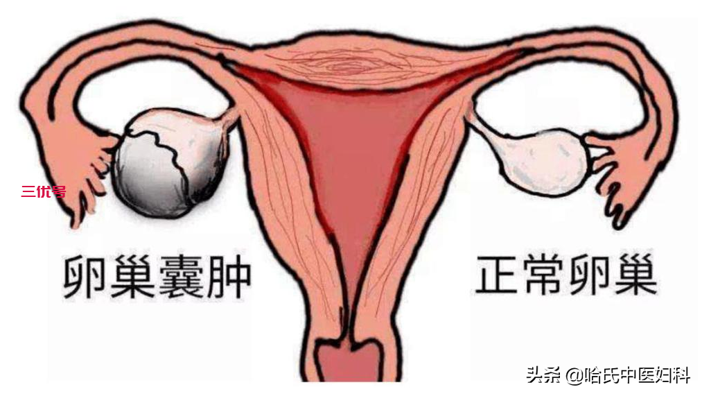 女性久婚不孕，小腹胀痛，月经不调！当心卵巢囊肿找上门