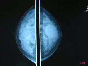乳腺钼靶检查是什么意思？乳腺钼靶怎么检查？