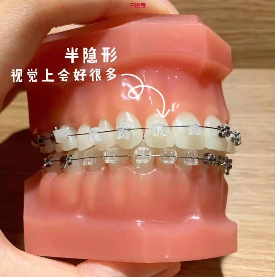 北京做牙齿矫正要多少钱啊？