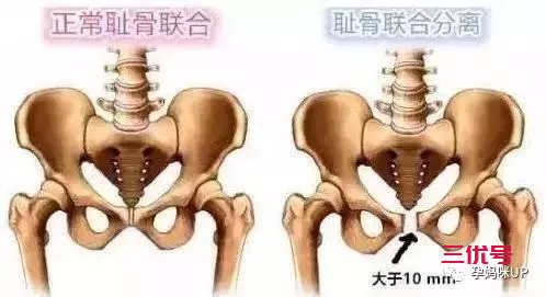 大腿根部疼痛？抬腿困难？也许是耻骨分离惹的祸！