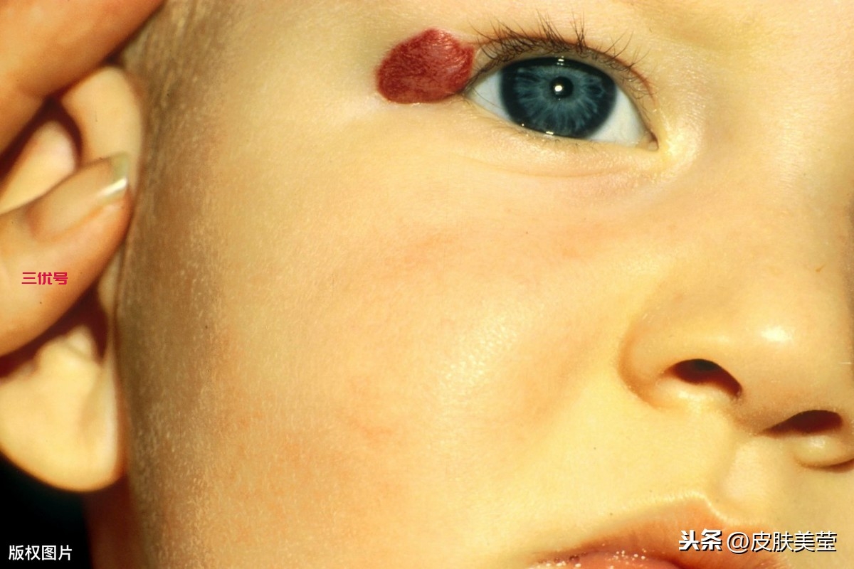 孩子脸上出现红色胎记，搞清这3种情况，处理得心应手