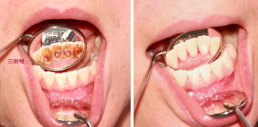 不起眼的牙结石危害却不小，以前都不知道，赶紧去洗牙才是关键