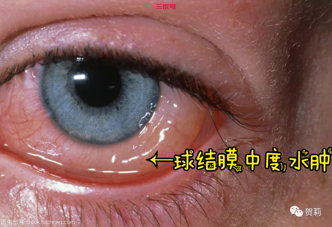 双眼痒伴有异物感、流泪，春夏之交换季眼痒之-“过敏性结膜炎”