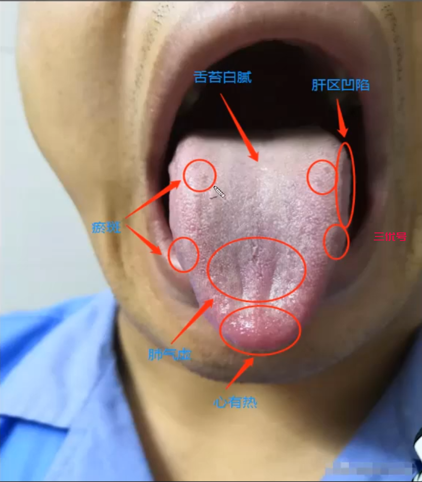 舌诊分析：舌头发尖，舌苔白，是肝气不舒吗？如何调理