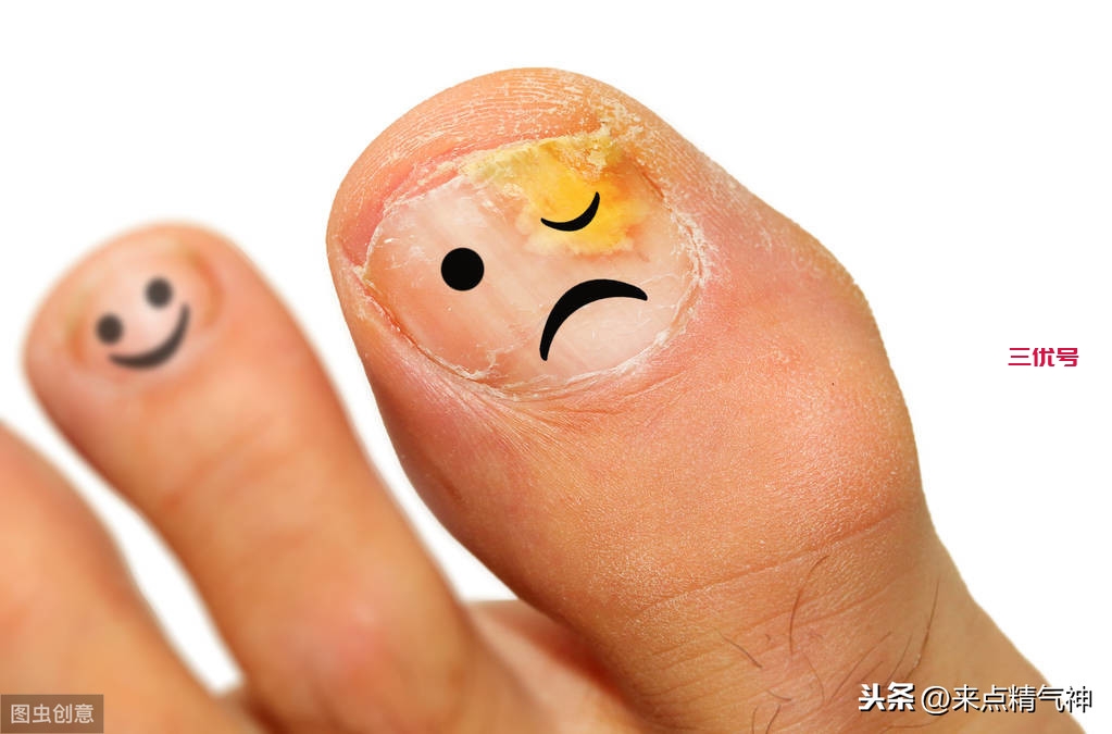 治灰指甲副作用大，不特别在意外观，可以不治