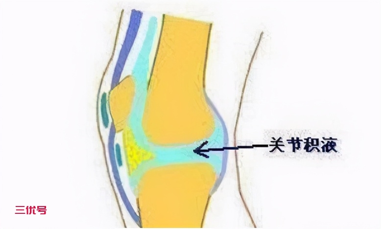 膝关节积液如何治疗才有效？医生建议这么做