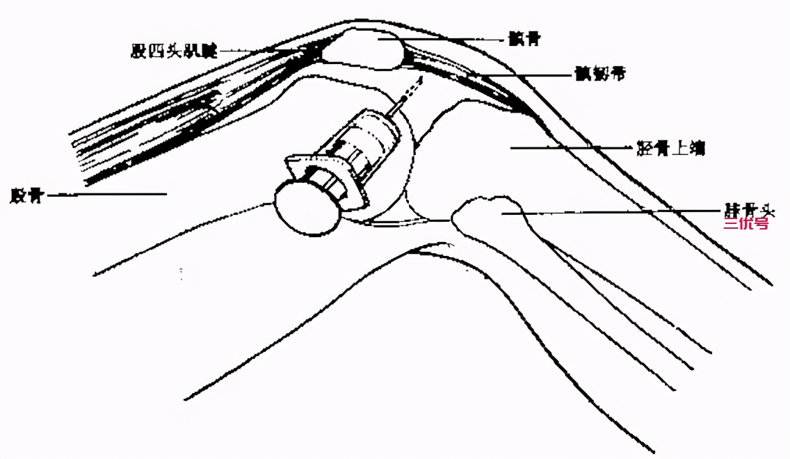 膝关节积液如何治疗才有效？医生建议这么做